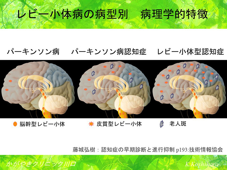 発症年齢と進行年齢